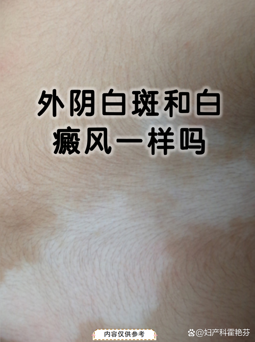 什么是妇科白斑图片,妇科白斑病是怎么回事